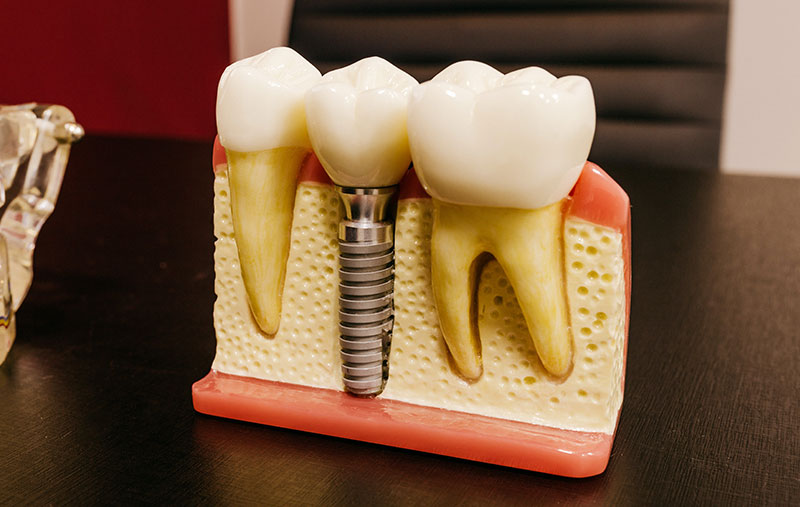implants dental inc matamoros