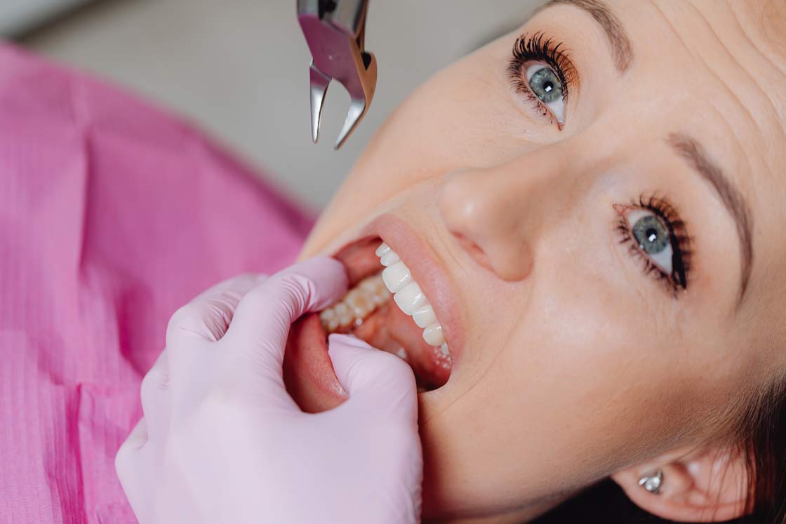 how-is-wisdom-tooth-extraction
