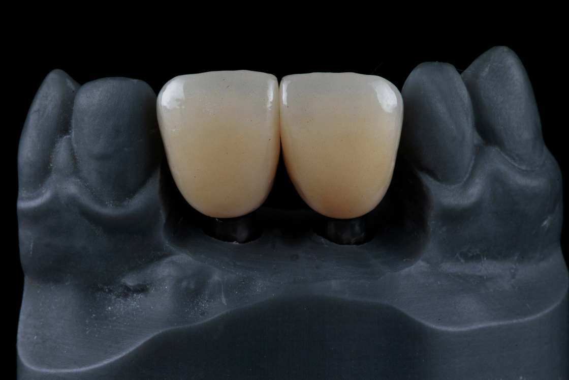 Dental Crowns Your Solution