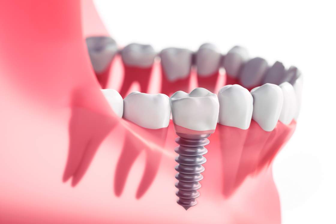 dental implants dental biodesign