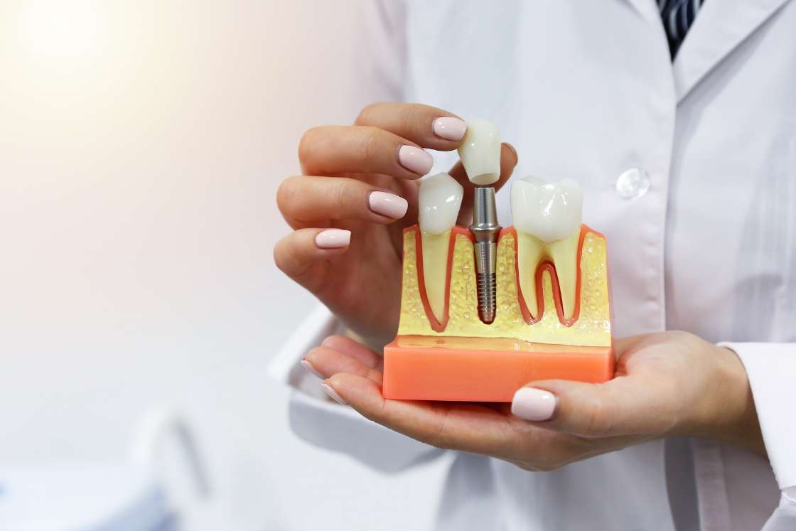 dental implants matamoros mexico