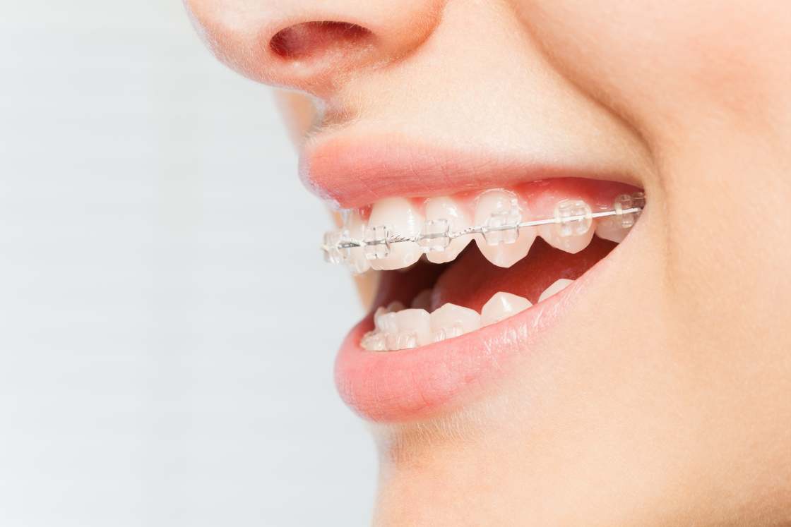 braces, to transform your smile