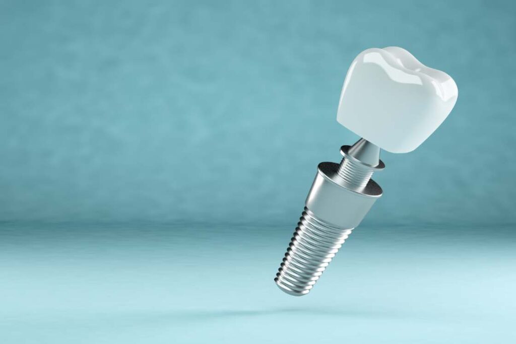 Dental ImplantsAnswersQuestions