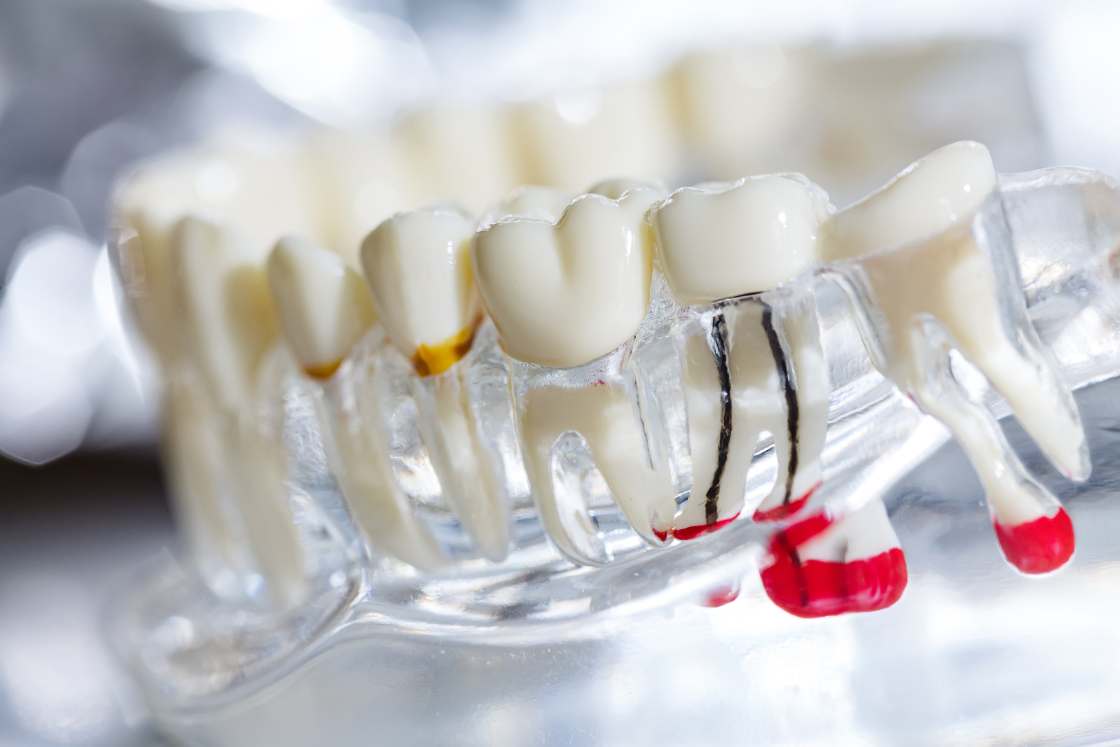 Myths and Facts About Root Canals