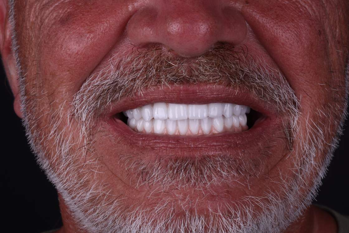 dental implants in México