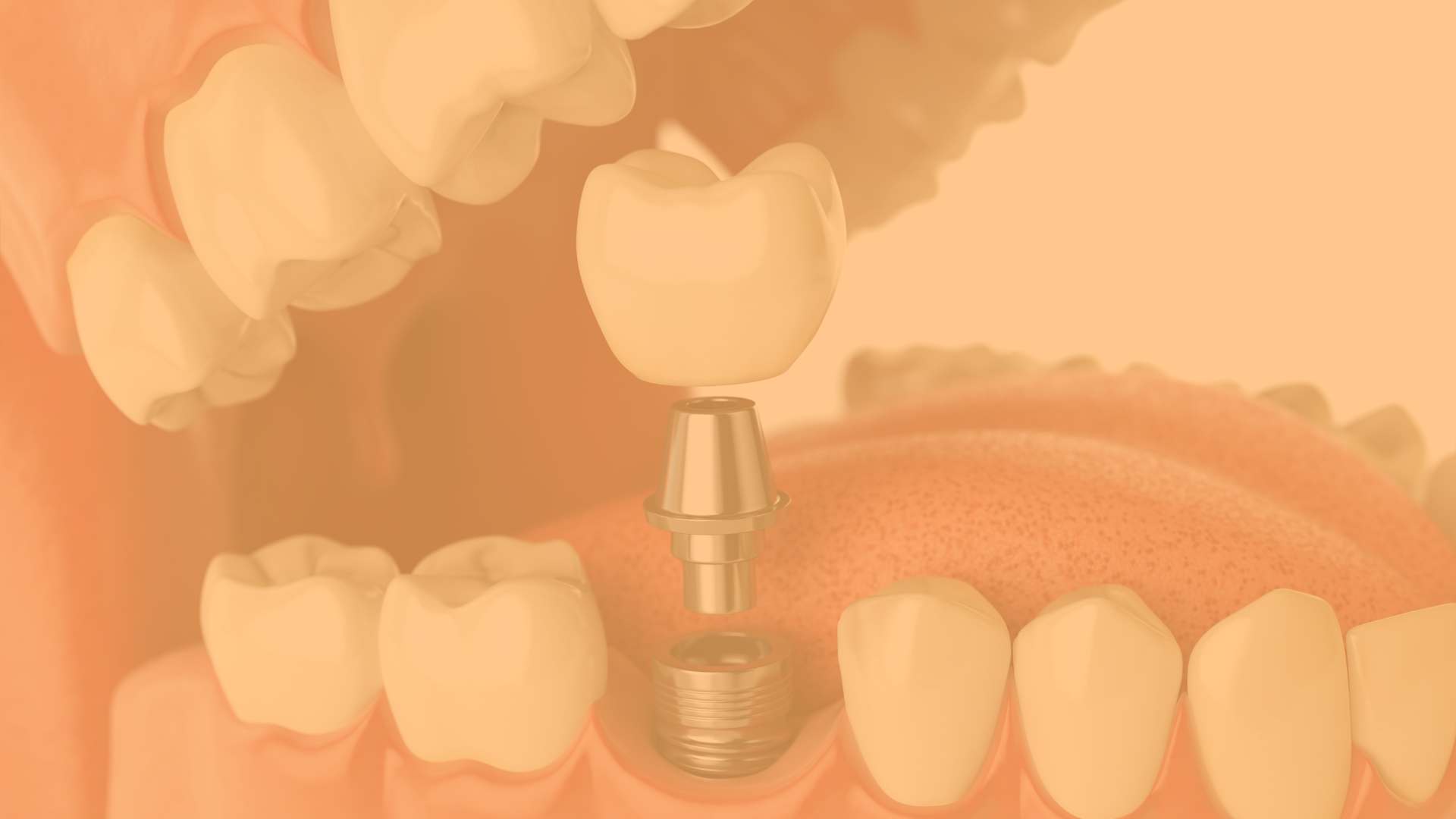 video dental implant
