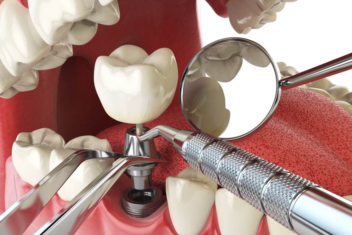 dental implants