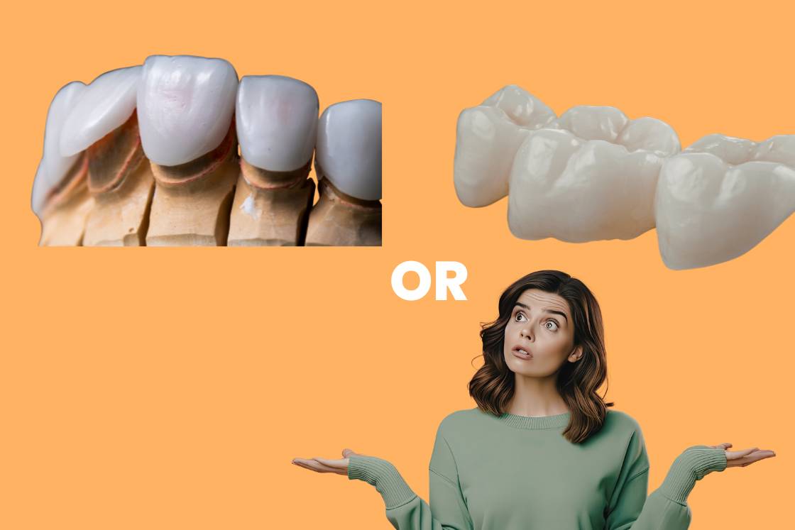 Veneers or Crowns