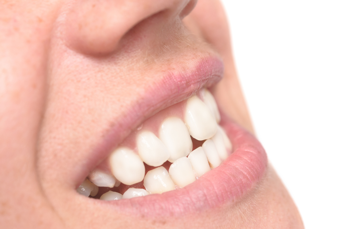 Bad Bite Leads to Tooth Loss Over Time