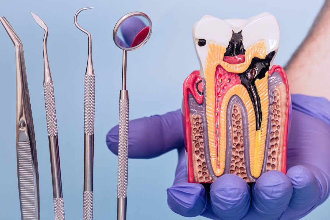 Try to Save Your Natural Tooth